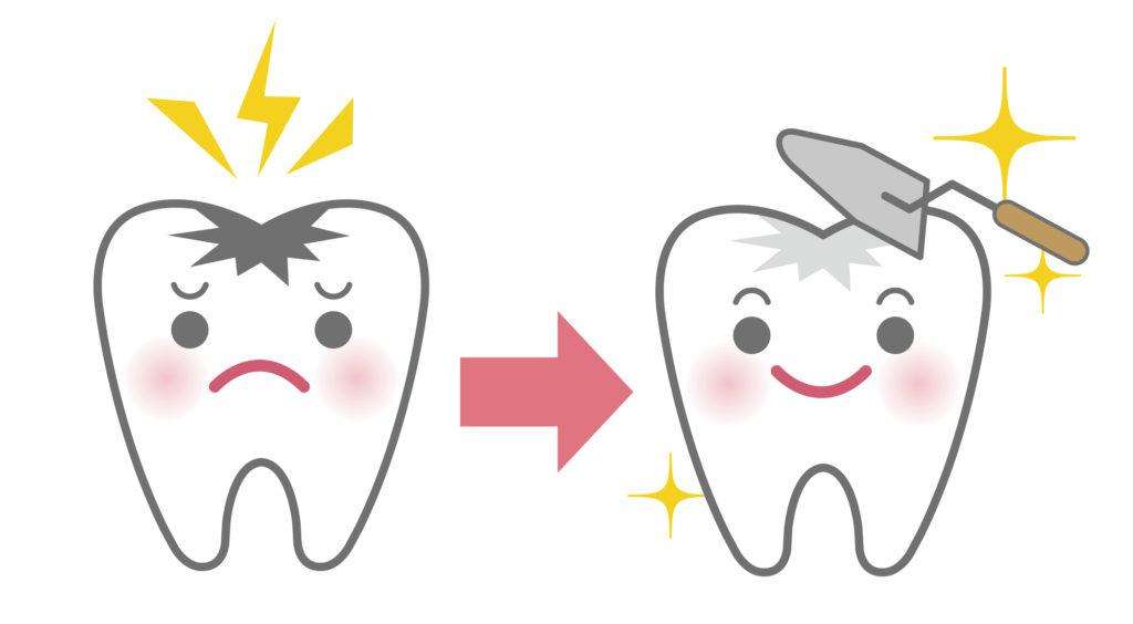保険の虫歯治療とは？JR摂津本山駅の岡本歯科ロコクリニック