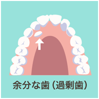 過剰歯ってご存知ですか？JR摂津本山駅の岡本歯科ロコクリニック